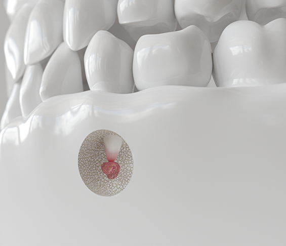 Illustration of a small red bump on the root of a tooth