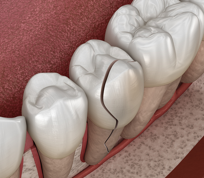 Illustrated close up of a cracked tooth in Bloomfield