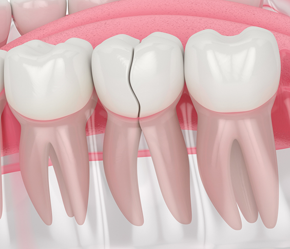 Illustration of a cracked tooth
