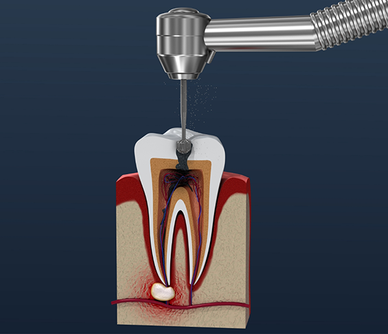 Illustration of a dental instrument treating the pulp inside of an infected tooth
