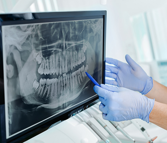 Dentist pointing to an x ray of teeth on a computer monitor