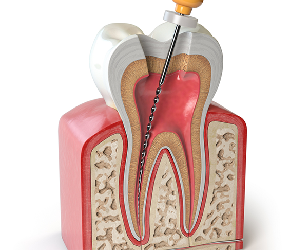 Illustration of a thin dental instrument treating the inside of a tooth during endodontic retreatment