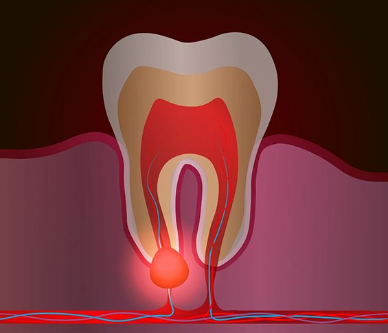 Illustration of a tooth with an infection in the root