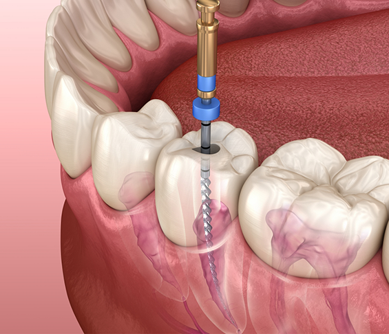 Illustration of a tooth undergoing endodontic retreatment