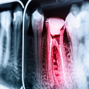 Factors that can affect root canal cost include the location of the infected tooth